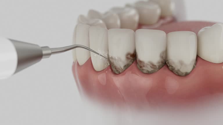 Reliable Dental Implants contractor in Lone Tree, IA by Smile Center Dentistry
